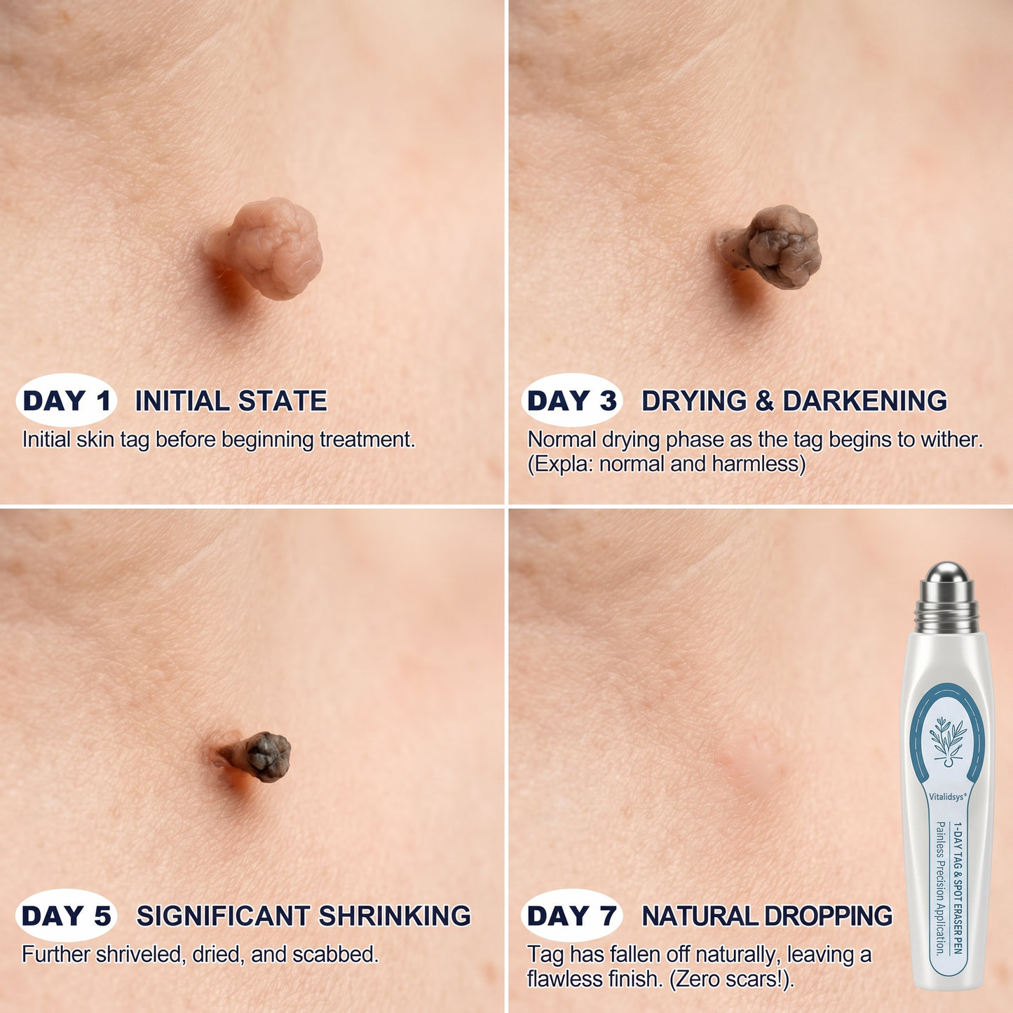 Authorized Flagship Store ✨|🍉𝐕𝐢𝐭𝐚𝐥𝐢𝐬𝐲𝐬® 7-𝐷𝑎𝑦 𝗧𝐚𝐠 & 𝗦𝗽𝐨𝐭 𝐄𝐫𝒂𝒔𝒆𝒓(Zero Pain, Zero 𝐒𝐜𝐚𝒓𝒔 Rollerball)🍉