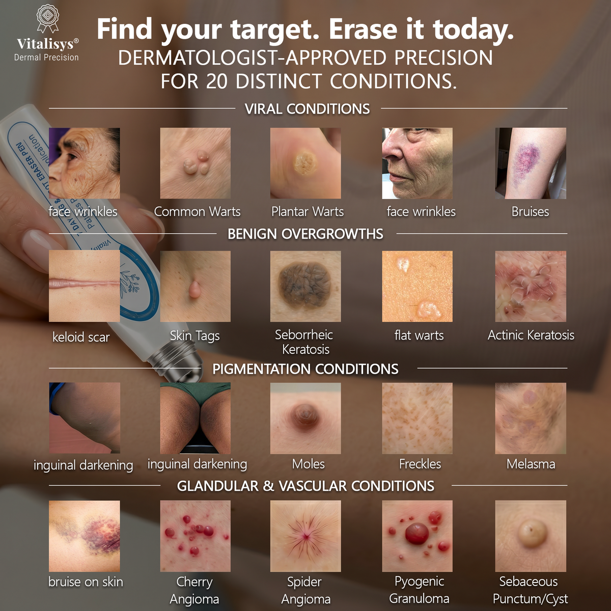 Authorized Flagship Store ✨|🍉𝐕𝐢𝐭𝐚𝐥𝐢𝐬𝐲𝐬® 7-𝐷𝑎𝑦 𝗧𝐚𝐠 & 𝗦𝗽𝐨𝐭 𝐄𝐫𝒂𝒔𝒆𝒓(Zero Pain, Zero 𝐒𝐜𝐚𝒓𝒔 Rollerball)|Removing moles, warts, facial wrinkles, bruises, scars✨