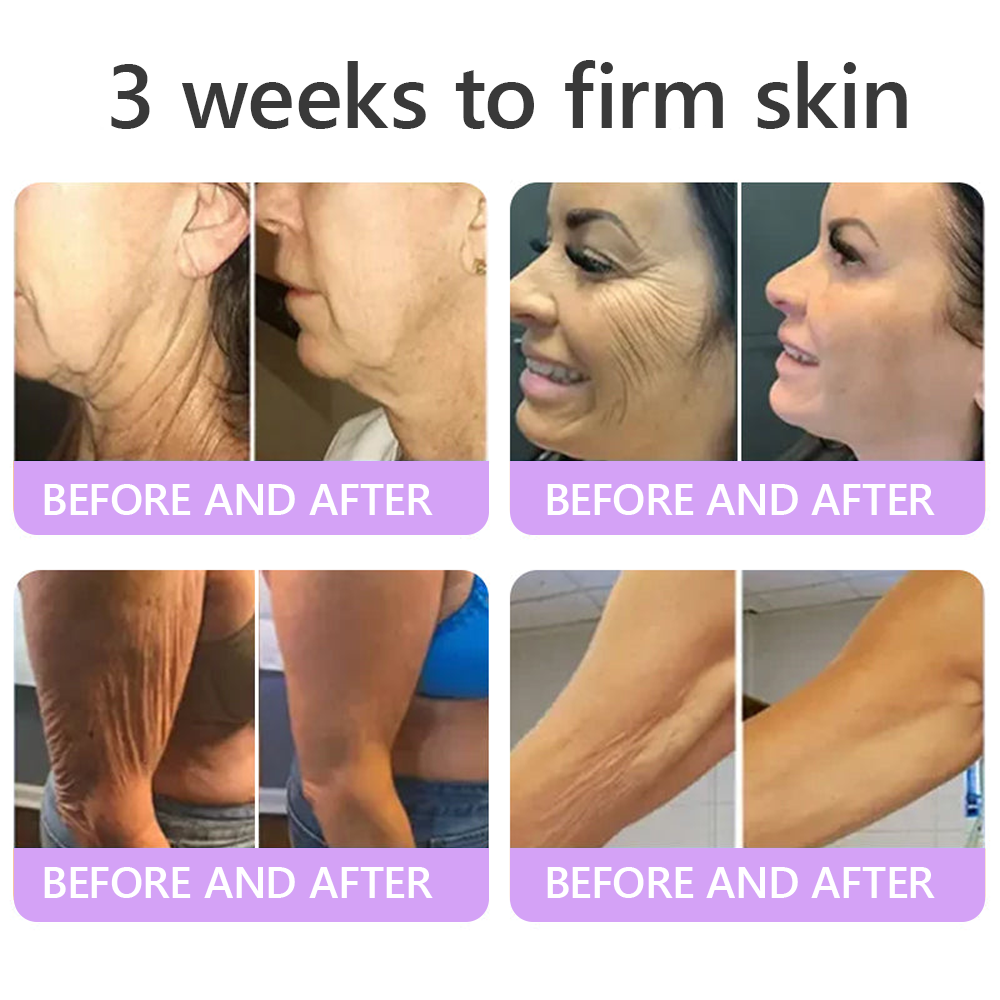Vitalisys® PDRN Multi-Peptide Massaging Body Roller Cream ✅- Anti-aging, Hydrating, Skin Firming & Lifting, Skin Repair, Even Tone, Acne and Dark Spot Treatment, Wart and Mole Removal, and Psoriasis Relief 🌷