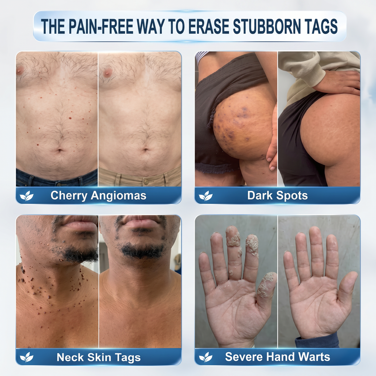 Authorized Flagship Store ✨|🍉𝐕𝐢𝐭𝐚𝐥𝐢𝐬𝐲𝐬® 7-𝐷𝑎𝑦 𝗧𝐚𝐠 & 𝗦𝗽𝐨𝐭 𝐄𝐫𝒂𝒔𝒆𝒓(Zero Pain, Zero 𝐒𝐜𝐚𝒓𝒔 Rollerball)🍉