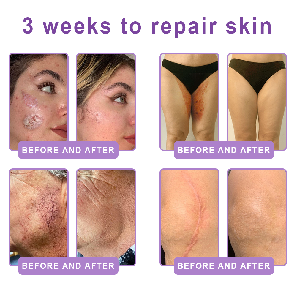Vitalisys® PDRN Multi-Peptide Massaging Body Roller Cream ✅- Anti-aging, Hydrating, Skin Firming & Lifting, Skin Repair, Even Tone, Acne and Dark Spot Treatment, Wart and Mole Removal, and Psoriasis Relief 🌷